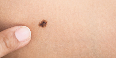 Birthmark on skin